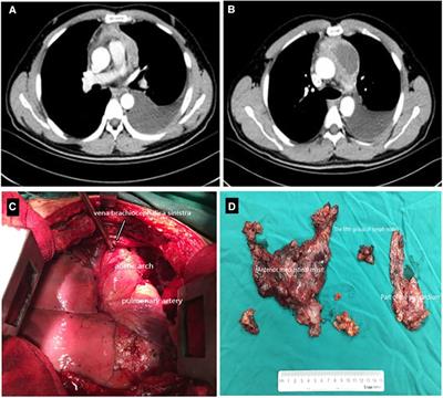 Case report: Anterior mediastinal mass in a patient with pleural effusion and dyspnea